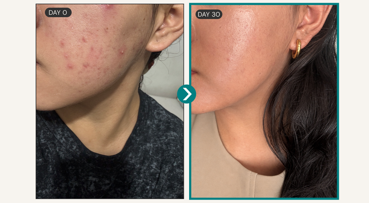 Day 0 and Day 30 skin result