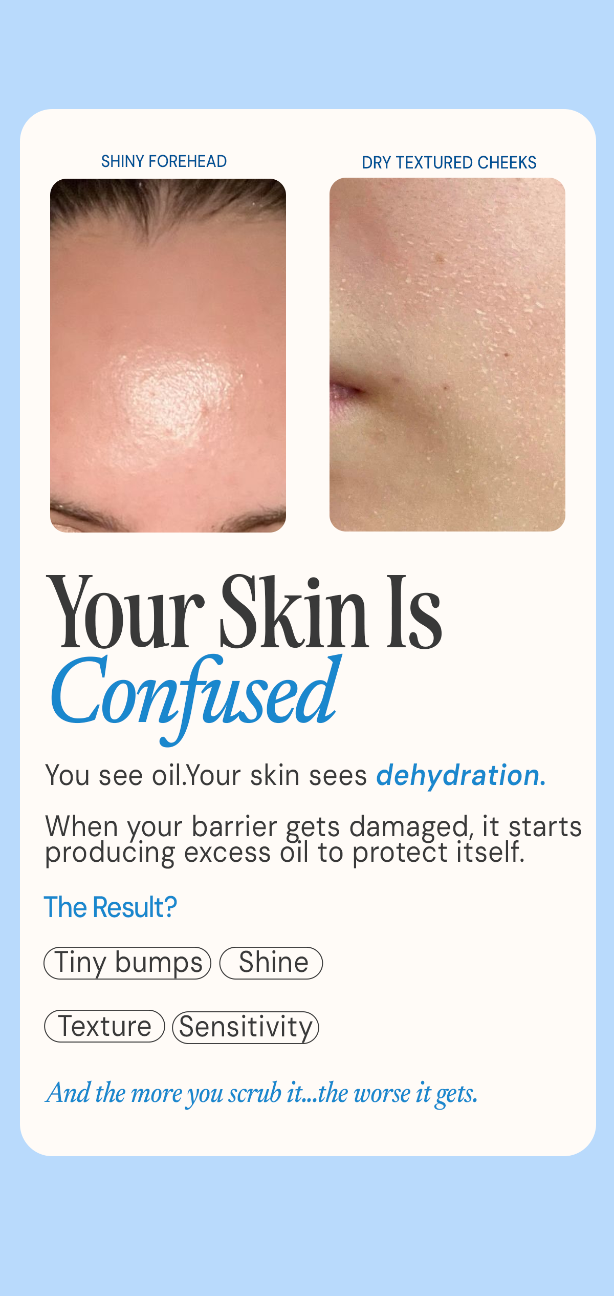 How dehydration can cause shine, tiny bumps, texture and sensitivity