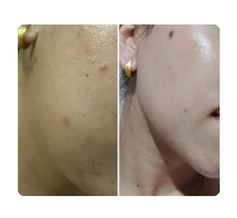 Customer before-and-after result while using Dr. Althea 345 Relief Cream